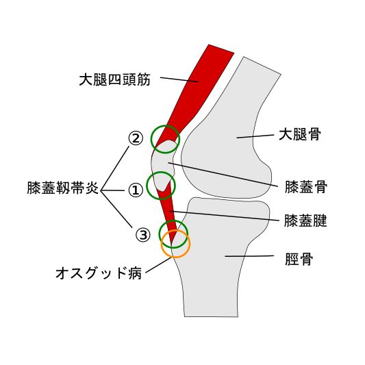 膝ケガ発症部位