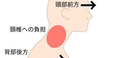 上位交差性症候群と肩こり