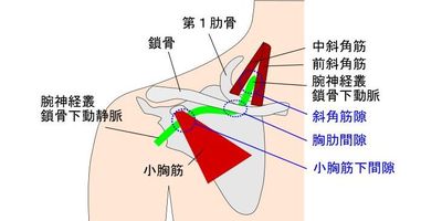 胸郭出口症候群イラスト