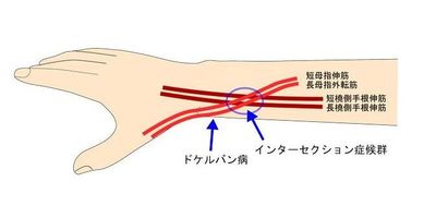 インターセクション症候群
