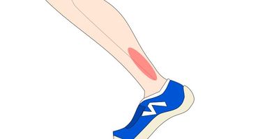 シンスプリントと疼痛部位