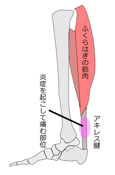 アキレス腱炎