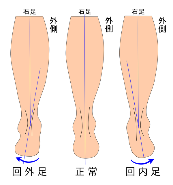 回内足・回外足