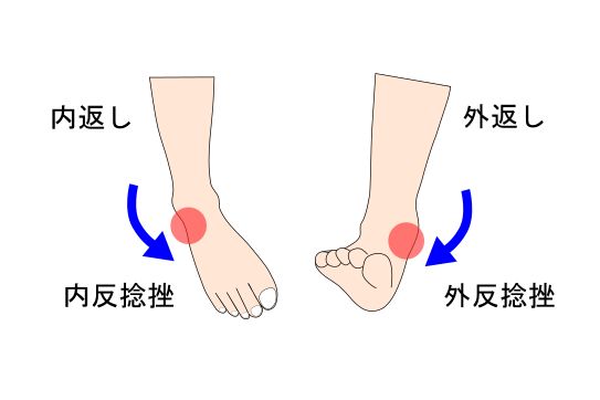 足関節捻挫のイラスト