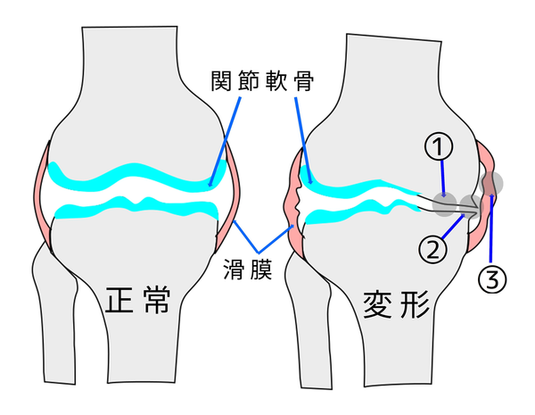 変形性膝関節症の図