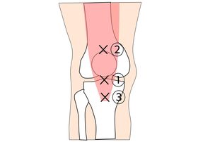 ジャンパー膝・膝蓋腱炎の痛み