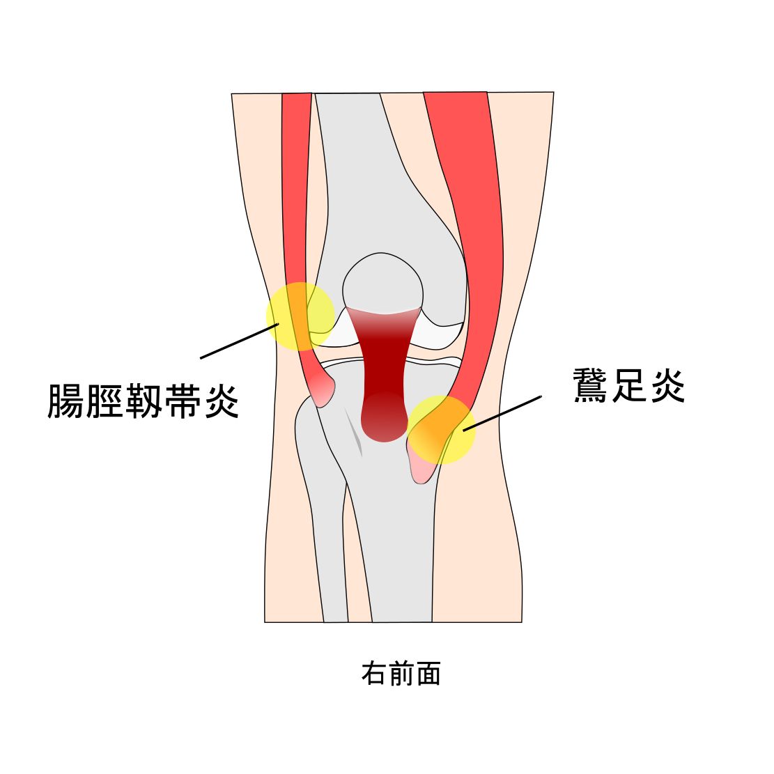 腸脛靱帯炎