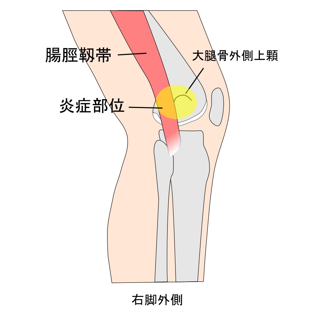 腸脛靱帯炎