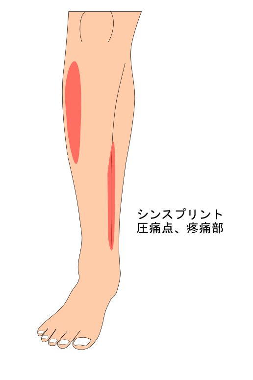 シンスプリントの疼痛部位