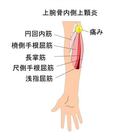 上腕骨内側上顆炎