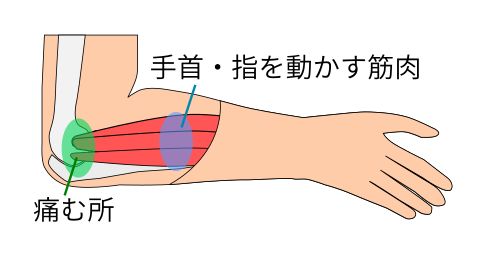 上腕骨外側上顆炎