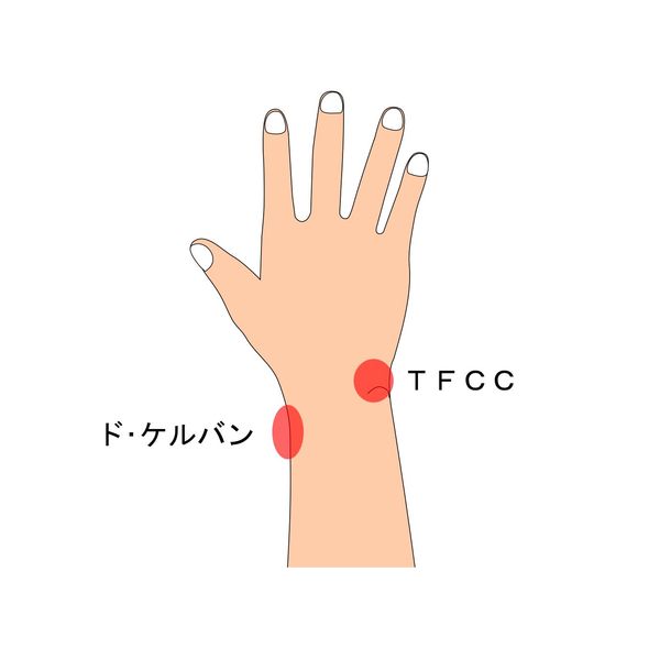 ド・ケルバン、TFCC