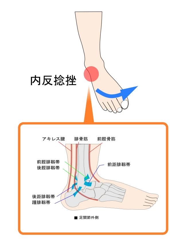 足首の内反捻挫