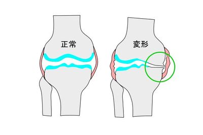 変形性膝関節症イラスト