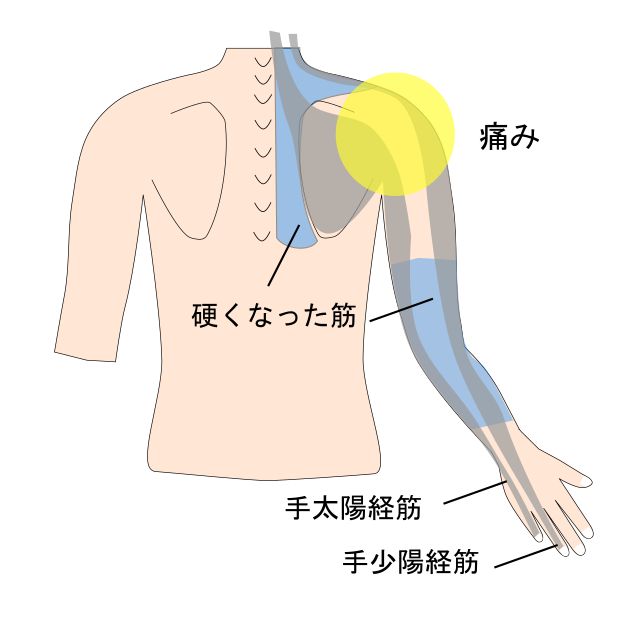 肩の痛みと経筋