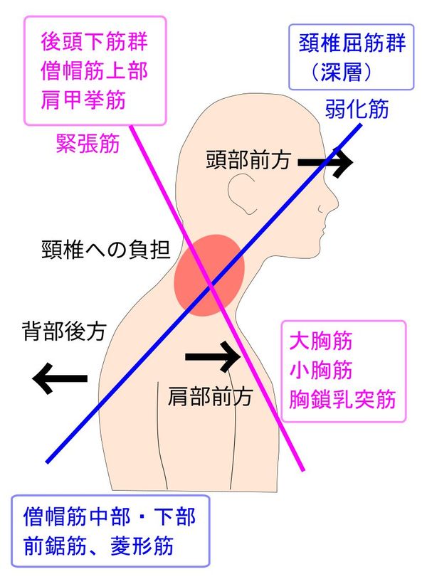 上位交差症候群