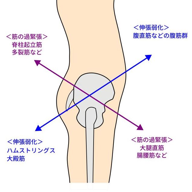 下位交差性症候群イラスト