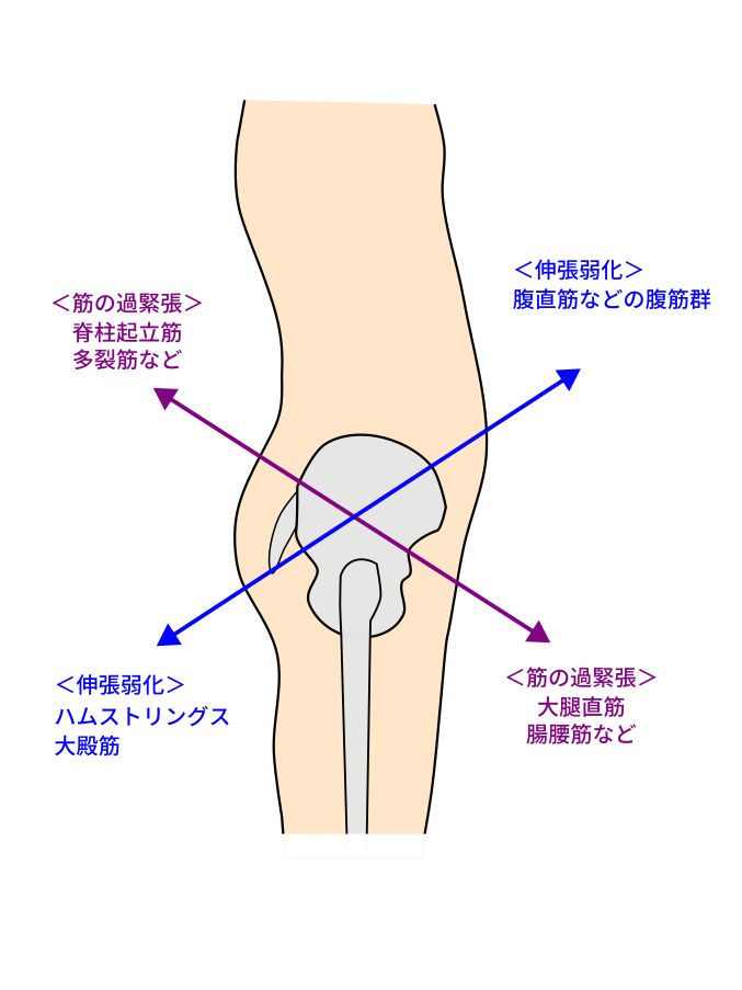 下位交差性症候群イラスト