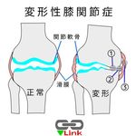 変形性膝関節症、膝の痛み